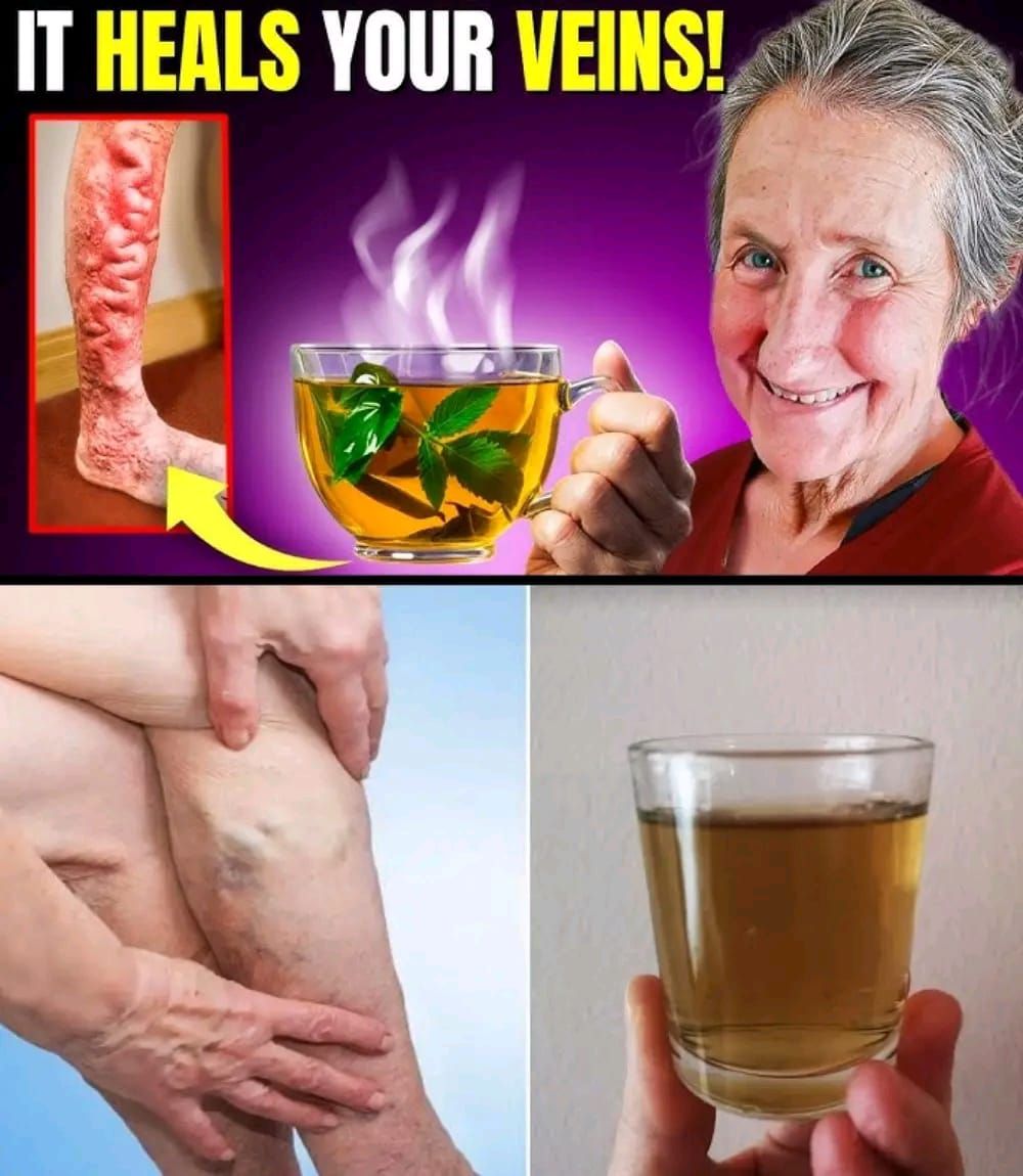 Understanding and Managing Varicose Veins Naturally: Causes, Symptoms, and Holistic Remedies