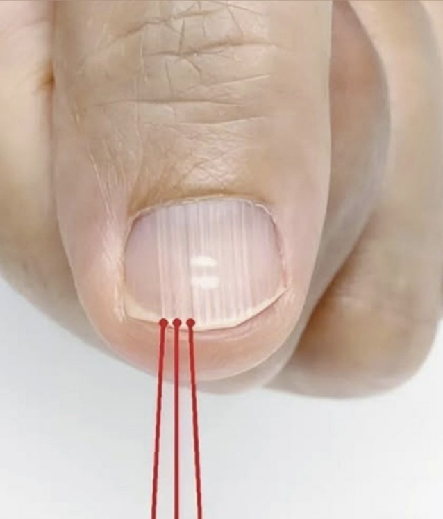 What Those Vertical Lines on Your Nails Really Reveal