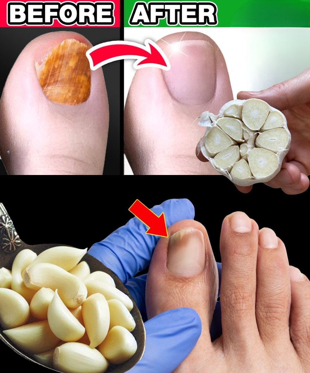Garlic for Nail Fungus: A Natural Cure for Healthy Nails